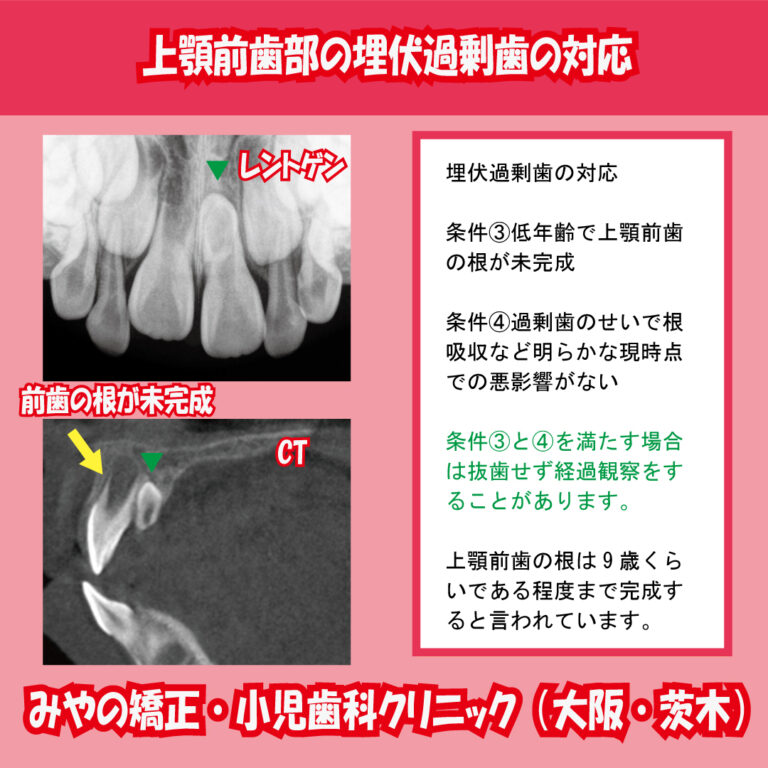 上顎前歯部埋伏過剰歯の対応2 矯正症例集みやの矯正・小児歯科クリニック